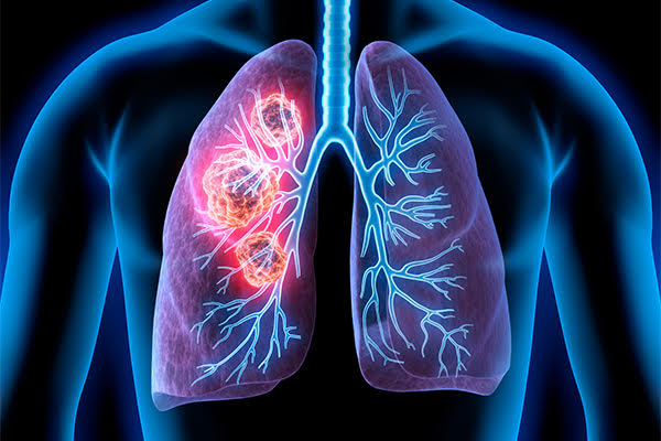 Breaking Ground in small cell lung cancer First Anti-PD-1 Antibody Gains UK Approval