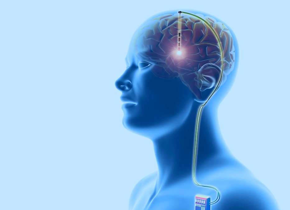 Precision Meets Innovation: SFDA Endorses Real-Time Brain Stimulation Technology for Parkinson's Disease