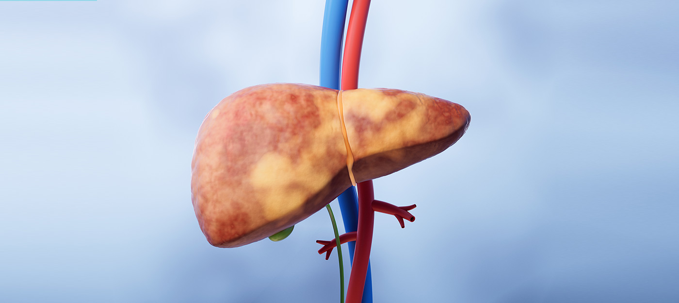 FDA qualifies First AI Tool to Speed MASH Drug Development